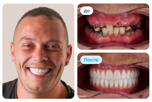 Сложный клинический случай до и после лечения