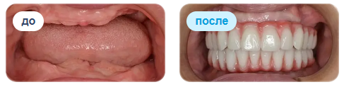 Пример современного несъемного зубного протеза